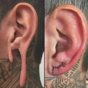 Déchirure Lobe Oreille Écarteur.