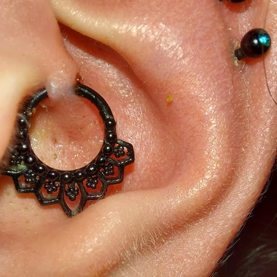 Rejet de piercing au daith (cartilage).