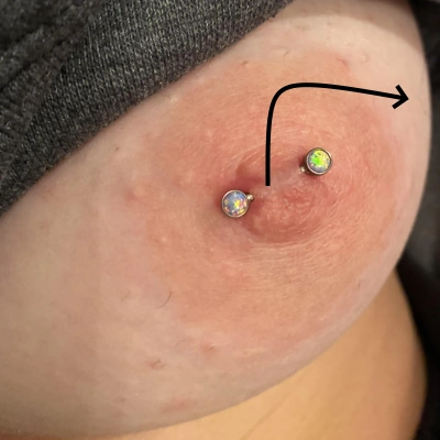 Rejet de piercing au téton.